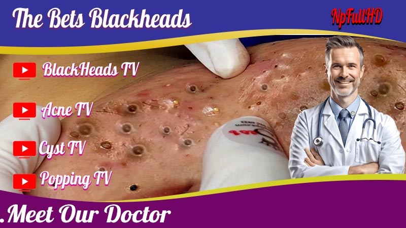 The Best Blackheads